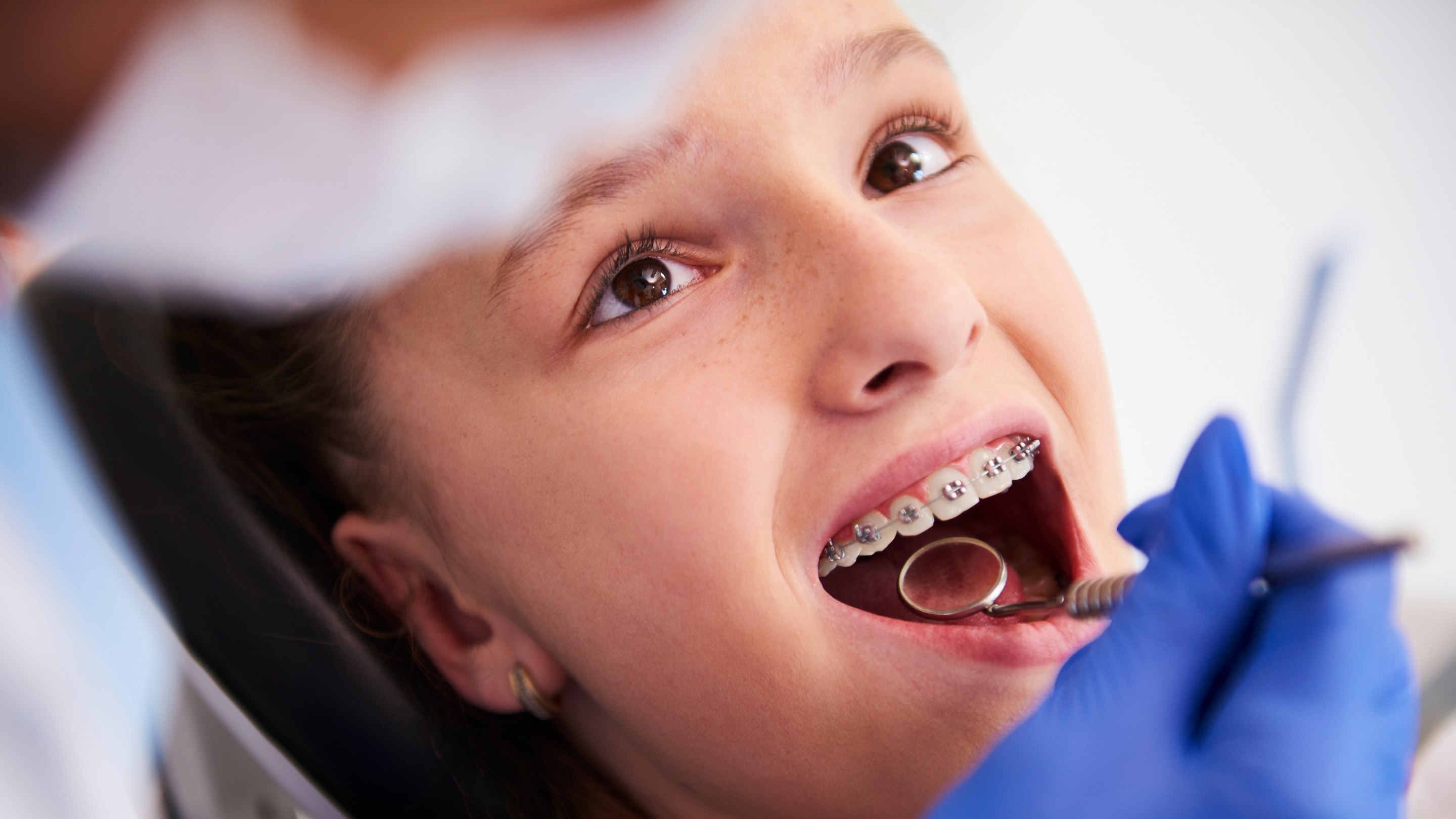 Braces treatment at SG Dental Clinic